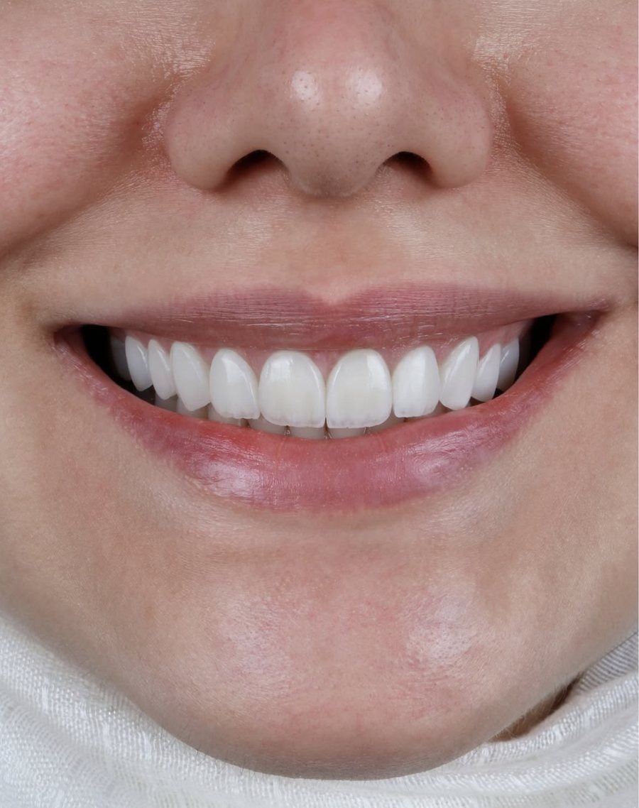 Hollywood Smile Design result