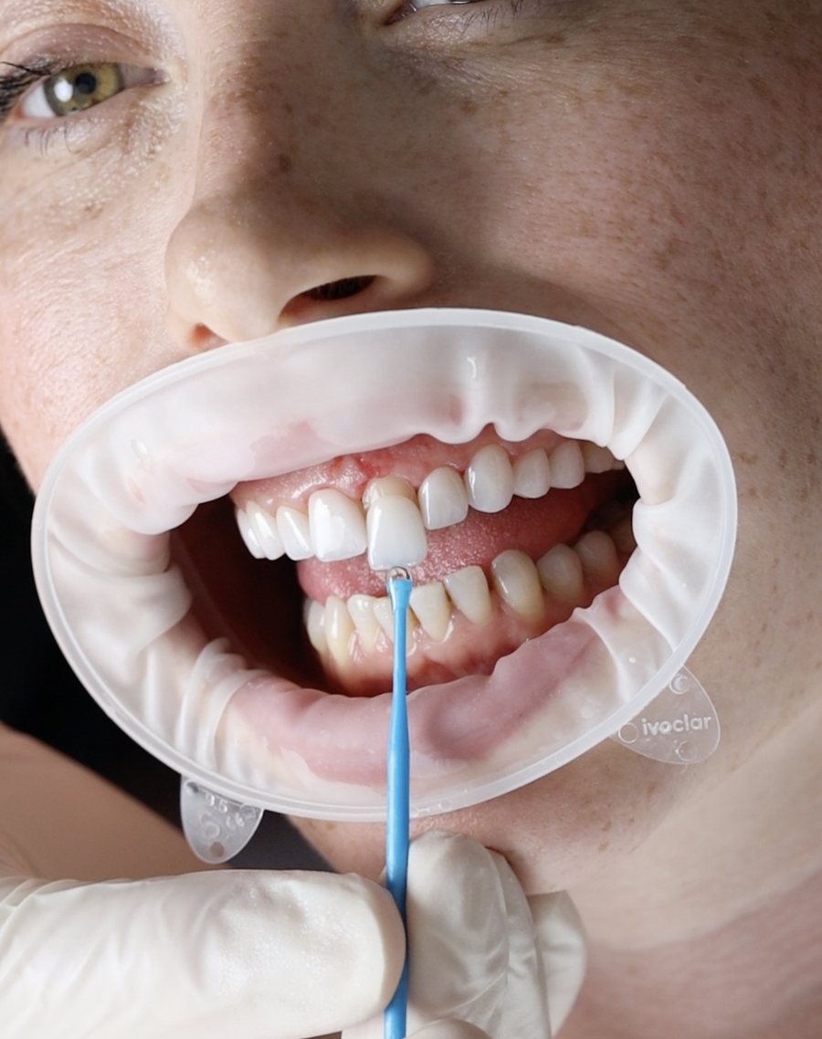 Veneers (E-Max & Porcelain) result