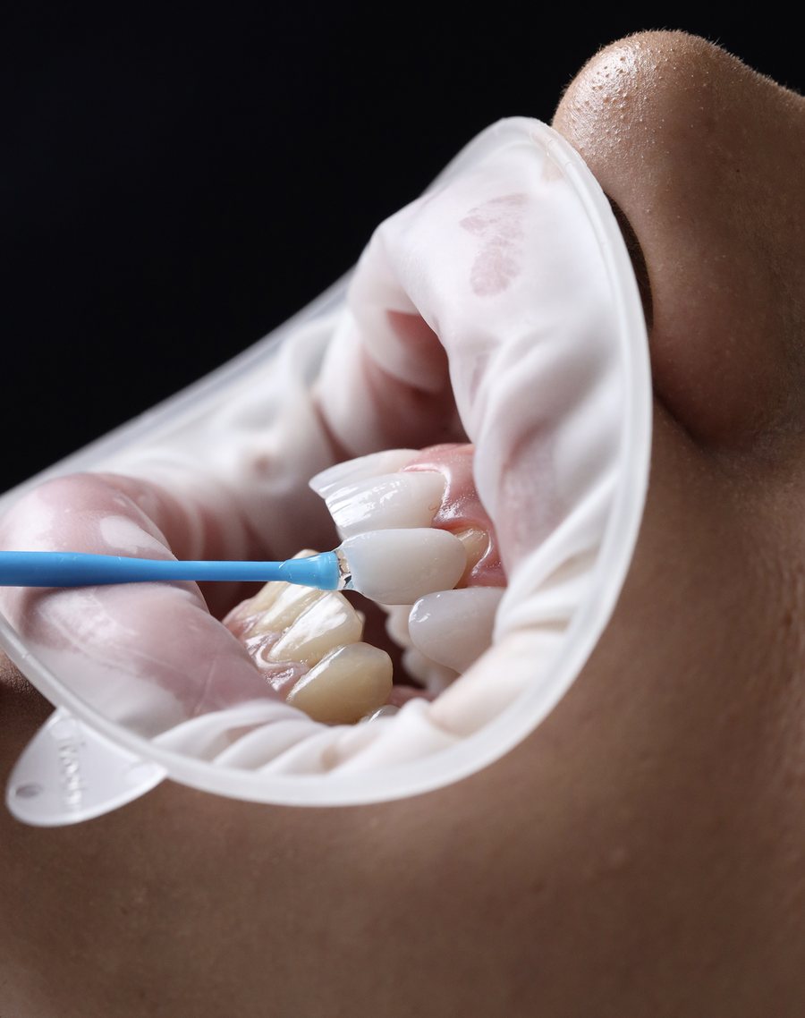 Zirconium Crowns & Bridges